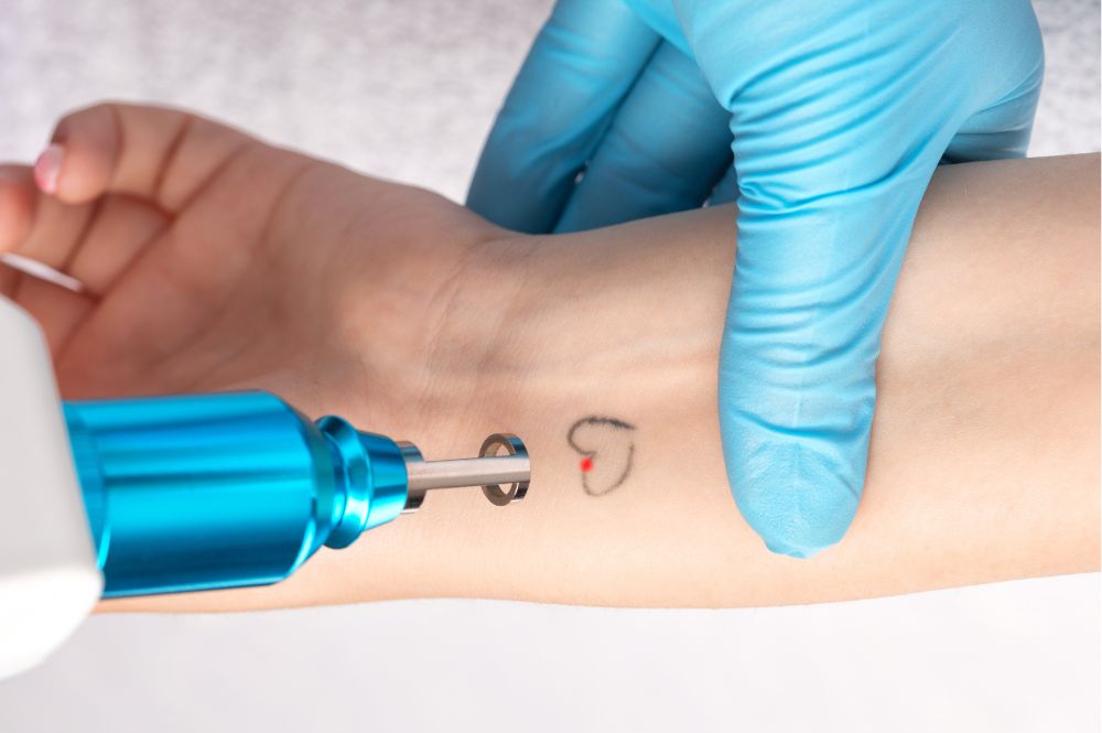 Tiny tattoos being removed from a woman's arm