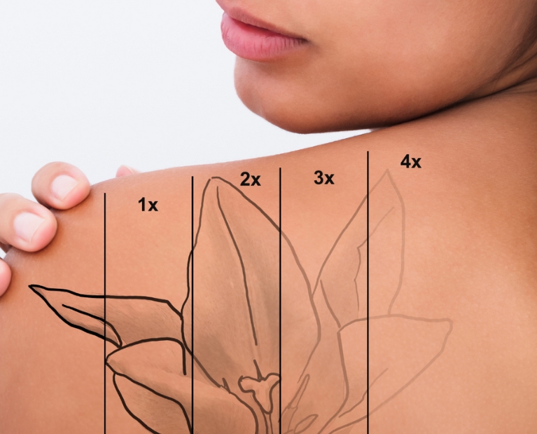 FYW Tatoo Removal