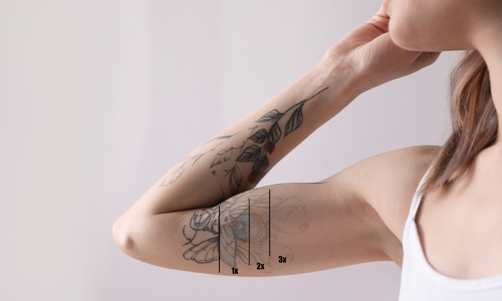 tattoo removal clinic near me
