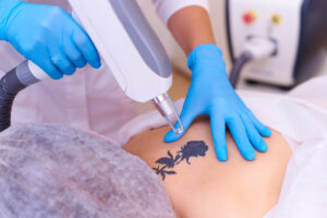 tattoo removal clinic