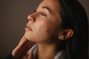 woman with acne