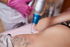 tattoo removal