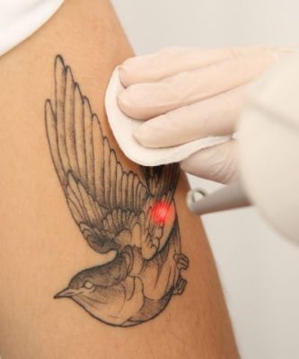 Woman receives a tattoo removal treatment