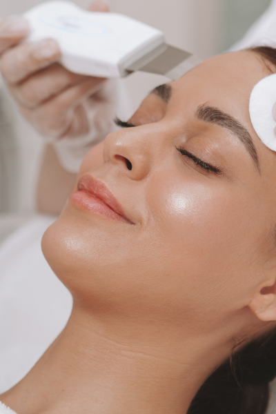 chemical peel for acne