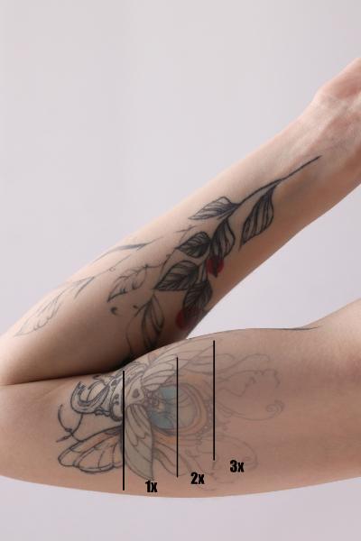 tattoo removal clinic near me